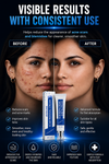 ScarSmooth™- Great for all types of marks